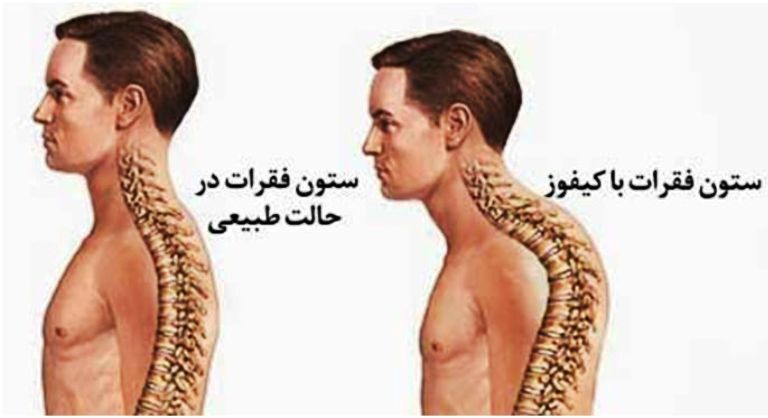 ناهنجاری کیفوز (گردپشتی- گوژپشتی- قوزپشتی)