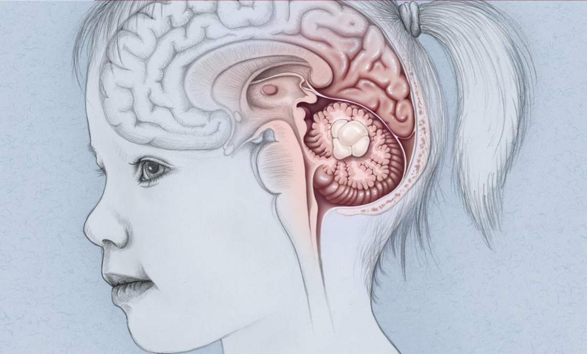 مزایای درمان تومورهای مغزی کودکان با رویکرد چند تخصصی