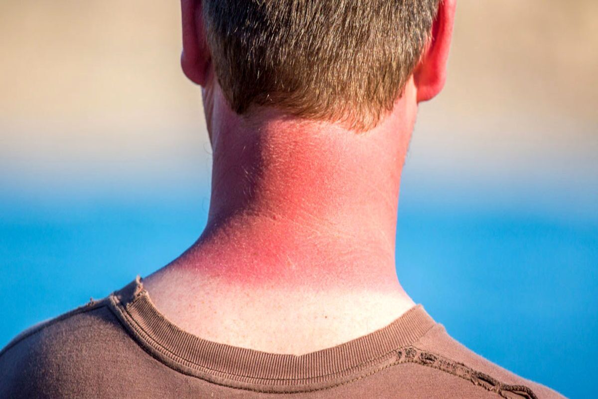 چگونه پوست آفتاب‌سوخته را درمان کنیم؟