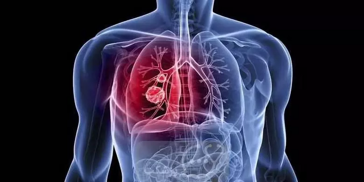 چرا درمان نوعی سرطان ریه در افراد غیرسیگاری جواب نمی‌دهد