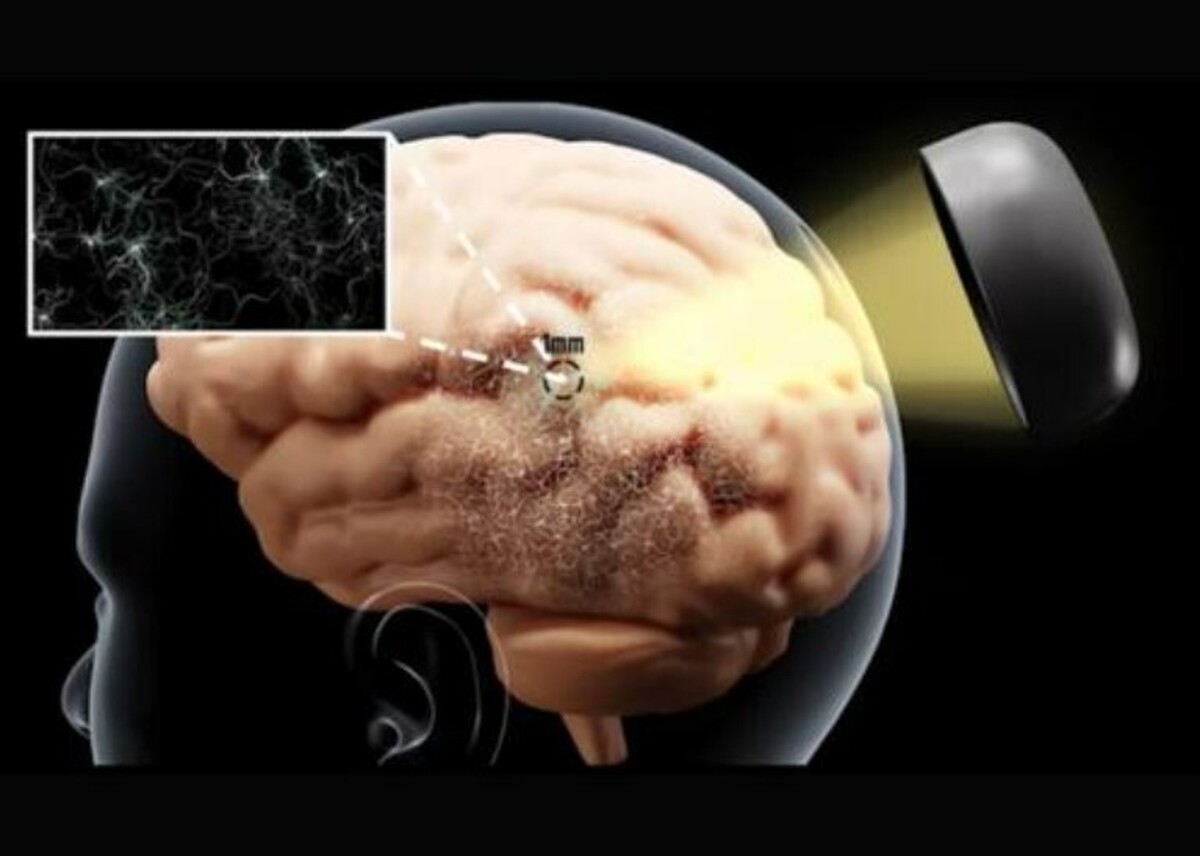 ابداع غیرتهاجمی‌ترین فناوری برای درمان بیماری‌های مغزی