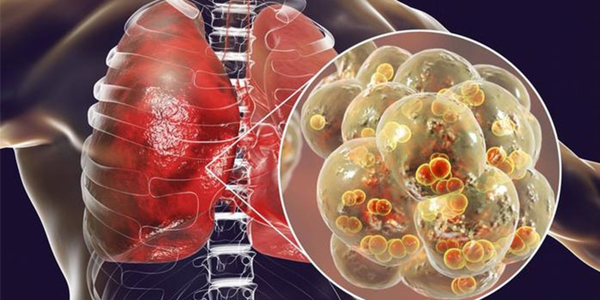 روش جدید محققان در درمان فیبروز ریه جواب داد