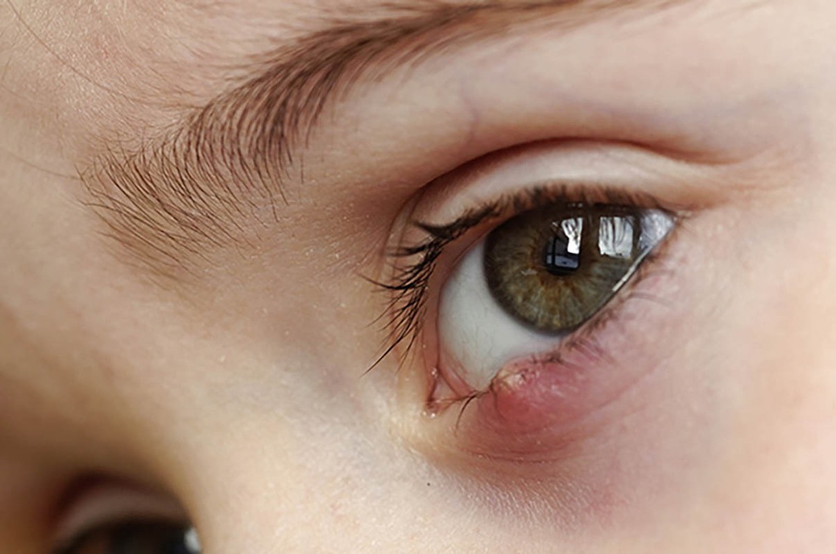 دلایل ایجاد گل‌مژه در پلک  دستکاری هر نوع ضایعه‌ در اطراف چشم خطرناک است