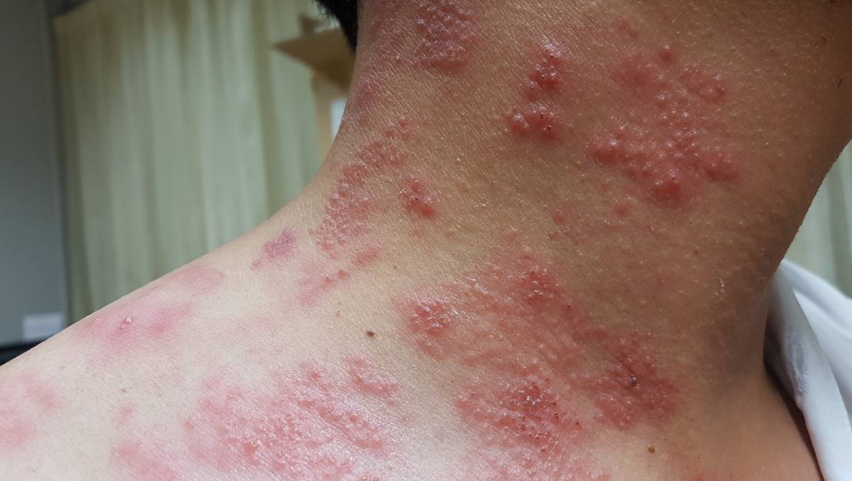 بررسی تفاوتهای آبله مرغان و زونا/ ضعف در سیستم ایمنی ابتلا به زونا را تشدید میکند بررسی تفاوتهای آبله مرغان و زونا/ ضعف در سیستم ایمنی ابتلا به زونا را تشدید میکند