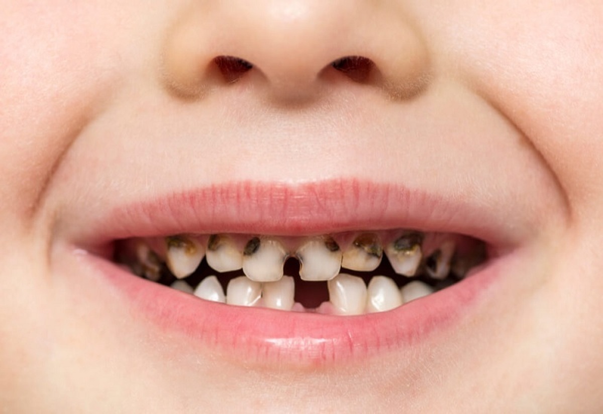 اهمیت مراقبت از دندان‌ها در سلامت کودکان کم توان و ناتوان
