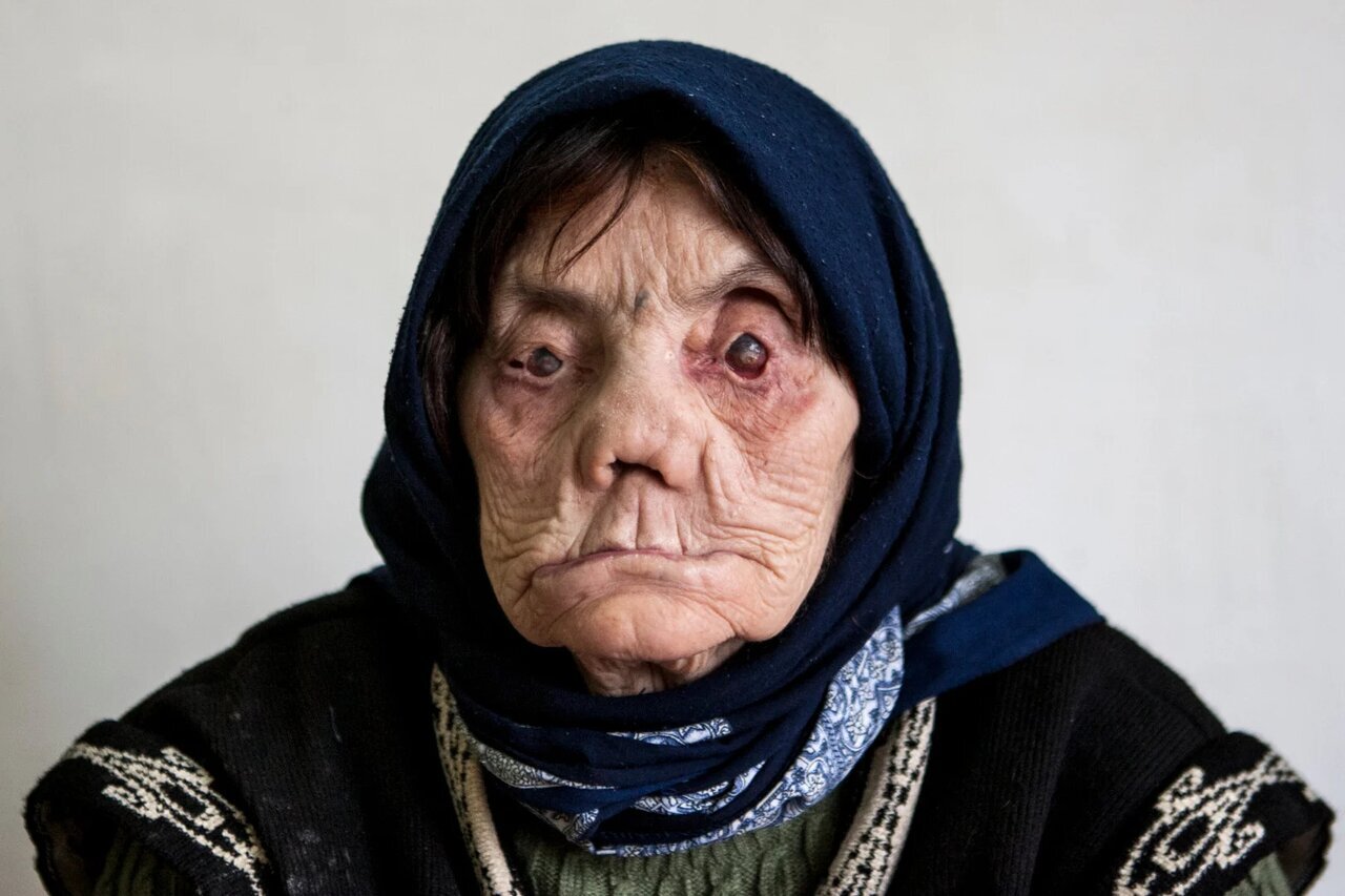 جذام هنوز هم در ایران وجود دارد/ راههای انتقال و علائم بیماری جذام هنوز هم در ایران وجود دارد/ راههای انتقال و علائم بیماری