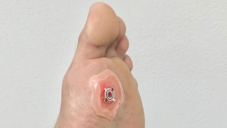 درمان چند ساعته زخم دیابتی با پانسمانی که با آب کار میکند درمان چند ساعته زخم دیابتی با پانسمانی که با آب کار میکند