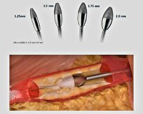 ارایه روش نوین بازکردن رگ‌های قلب با الماس چرخنده
