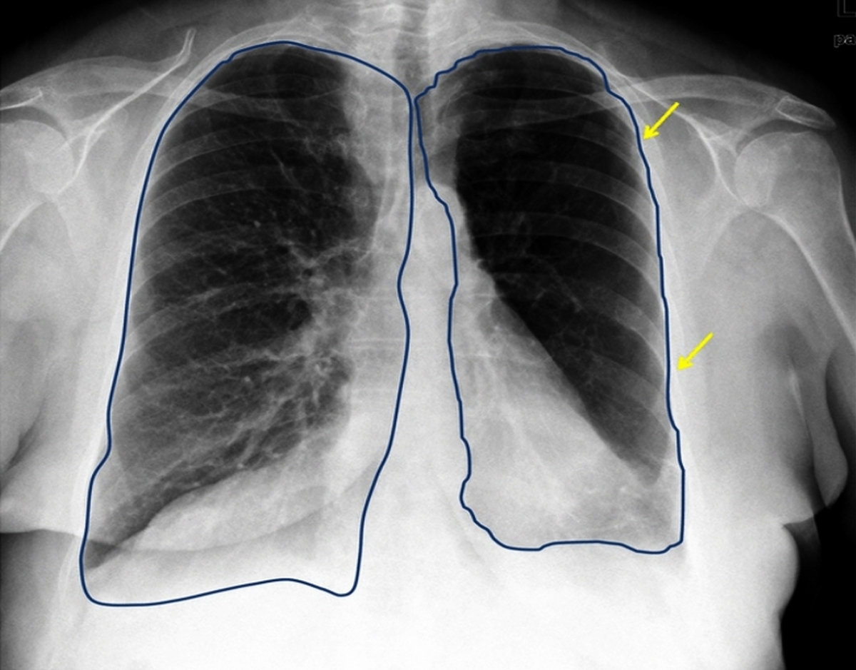 ریه چپ شما از ریه راست‌تان کوچک‌تر است!