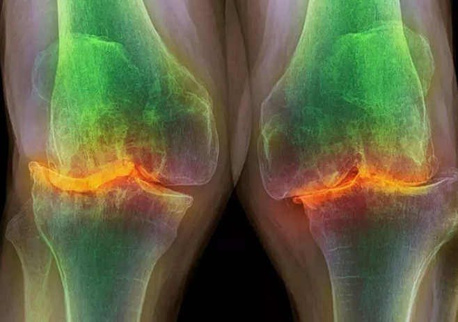 آرتروز بیماری دوره میانسالی و سالمندی/ آیا جوانان دچار آرتروز میشوند؟ آرتروز بیماری دوره میانسالی و سالمندی/ آیا جوانان دچار آرتروز میشوند؟