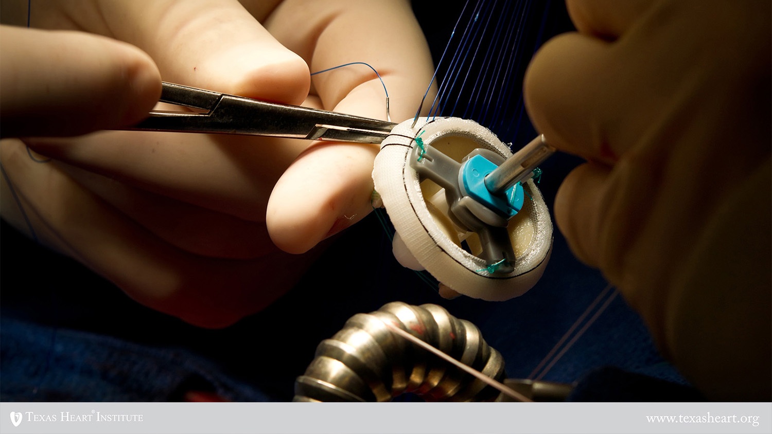 ۱۱ حقیقت درباره «قلب مصنوعی»/ اولین پیوند قلب مصنوعی دائمی در 1982 صورت گرفت! ۱۱ حقیقت درباره «قلب مصنوعی»/ اولین پیوند قلب مصنوعی دائمی در 1982 صورت گرفت!