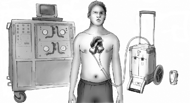 ۱۱ حقیقت درباره «قلب مصنوعی»/ اولین پیوند قلب مصنوعی دائمی در 1982 صورت گرفت!
