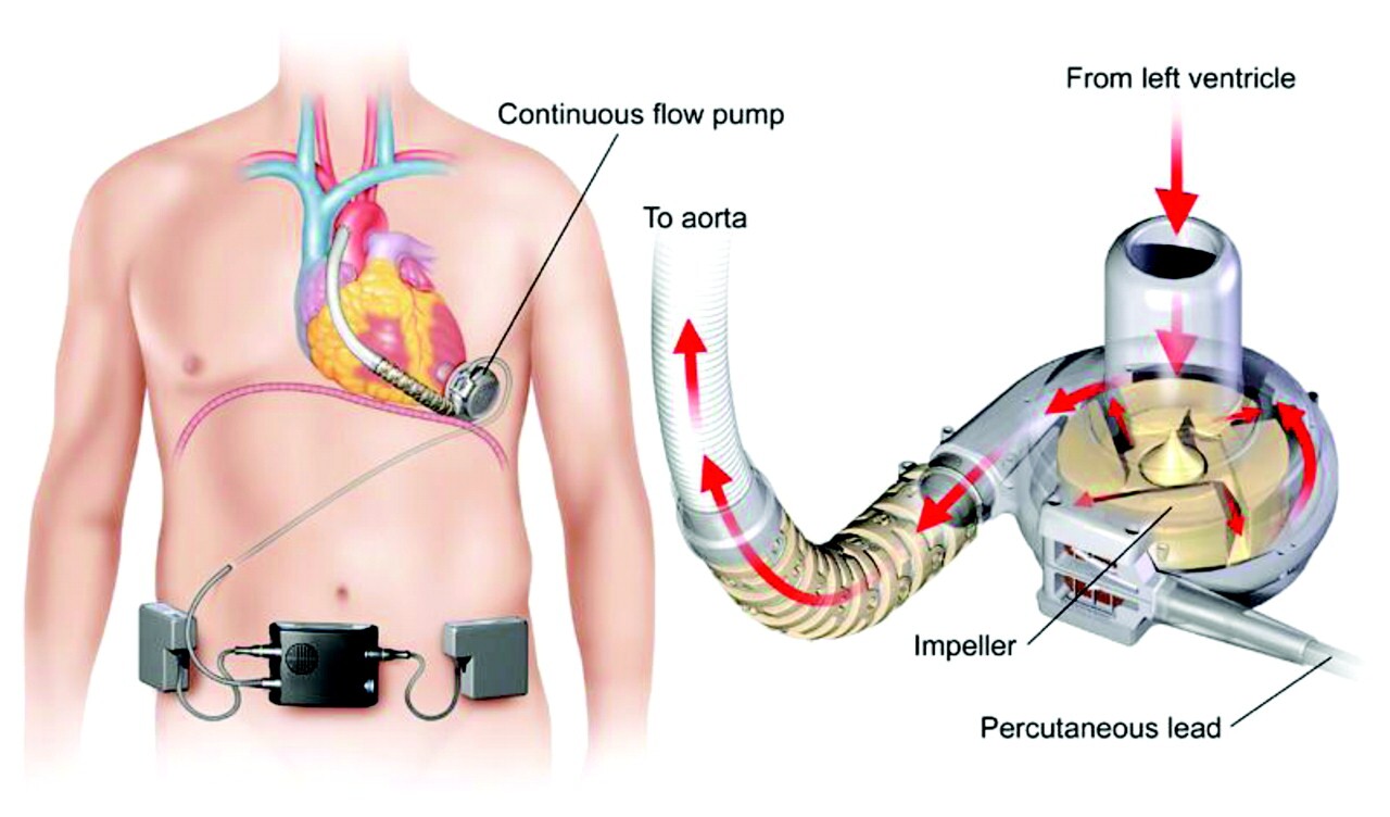 ۱۱ حقیقت درباره «قلب مصنوعی»/ اولین پیوند قلب مصنوعی دائمی در 1982 صورت گرفت!