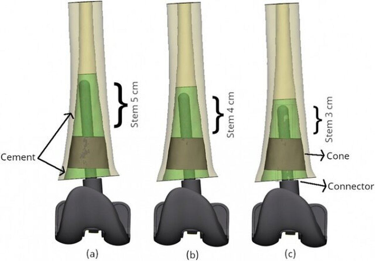 طراحی و ساخت ایمپلنت مکمل پروتز زانو با قدرت تثبیت استخوانی بیشتر