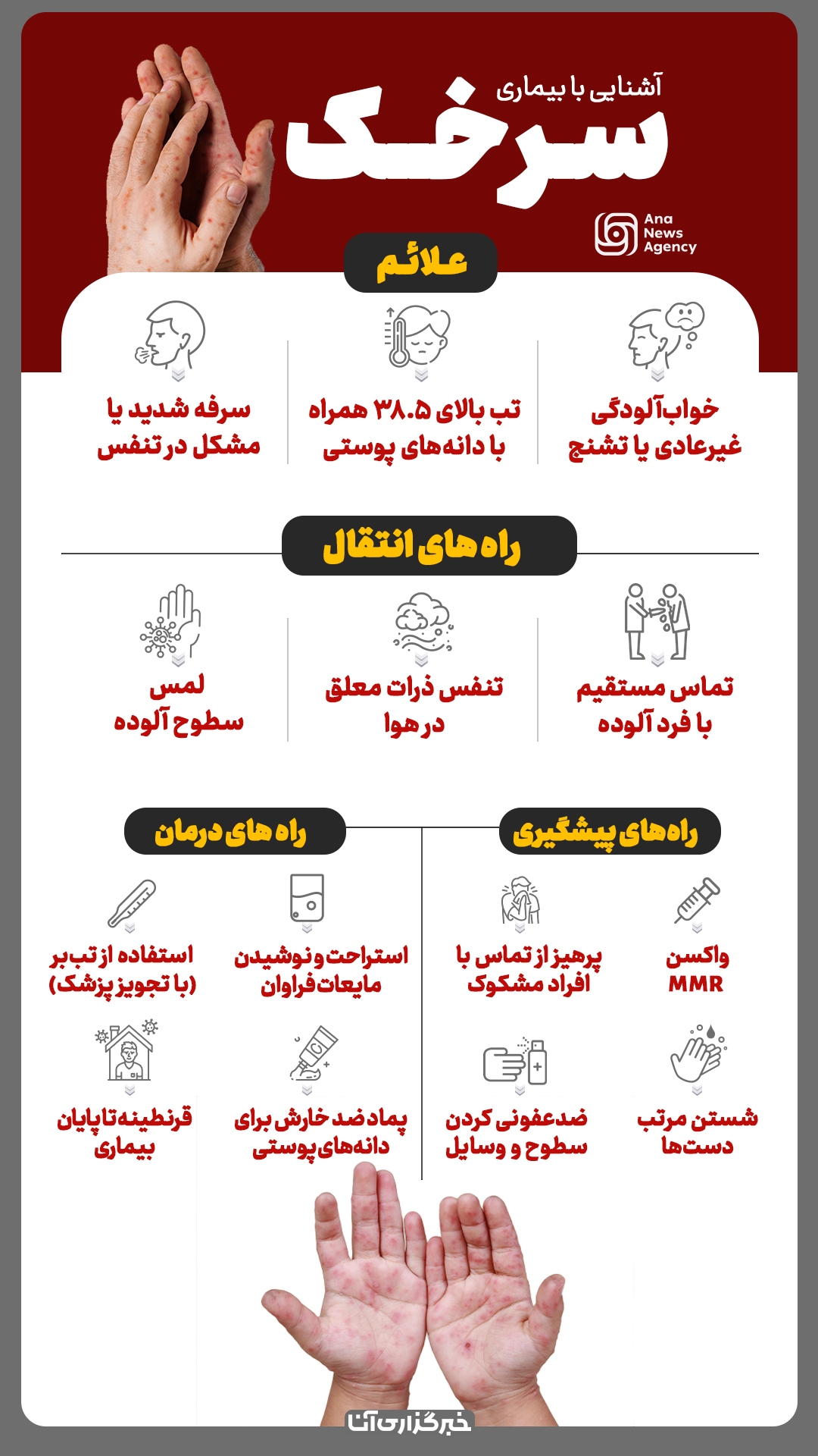 علائم، پیشگیری و درمان سرخک علائم، پیشگیری و درمان سرخک