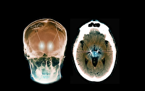 ایمپلنت مغزی شخصی‌سازی شده، نجات‌بخش زن مبتلا به وسواس شدید