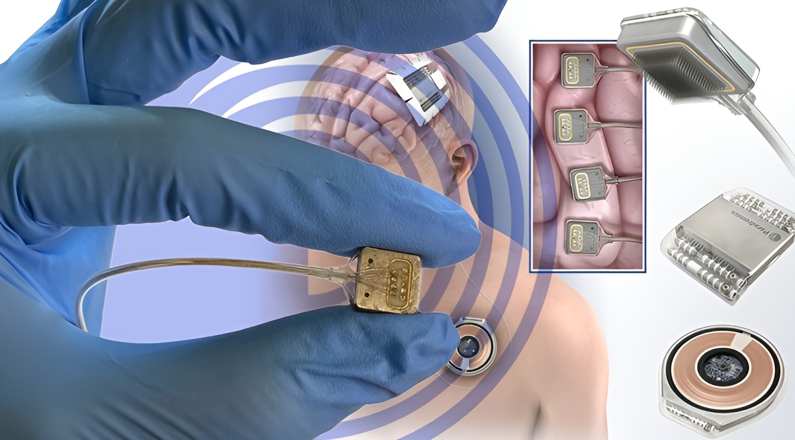 رقیب نورولینک اولین ایمپلنت مغزی خود را در انسان آزمایش کرد رقیب نورولینک اولین ایمپلنت مغزی خود را در انسان آزمایش کرد