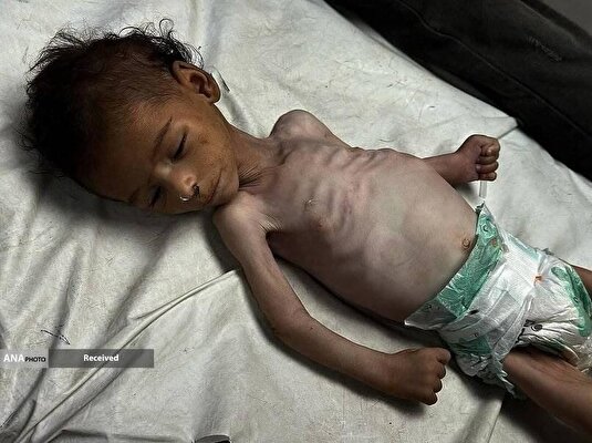 گرسنگی فاجعه بار در غزه