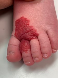 ماه گرفتگی پوستی؛ ردی که ژن‌ها بر تن می‌‌گذارند