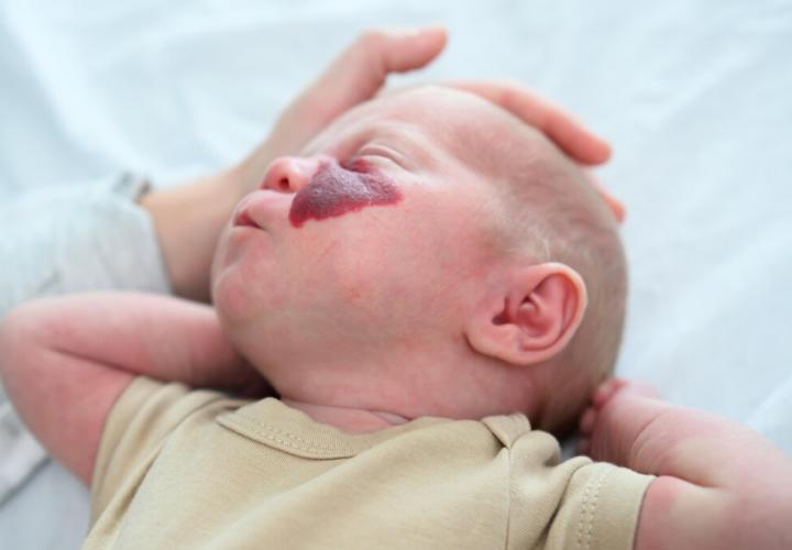 ماه گرفتگی پوستی؛ ردی که ژن‌ها بر تن می‌‌گذارند