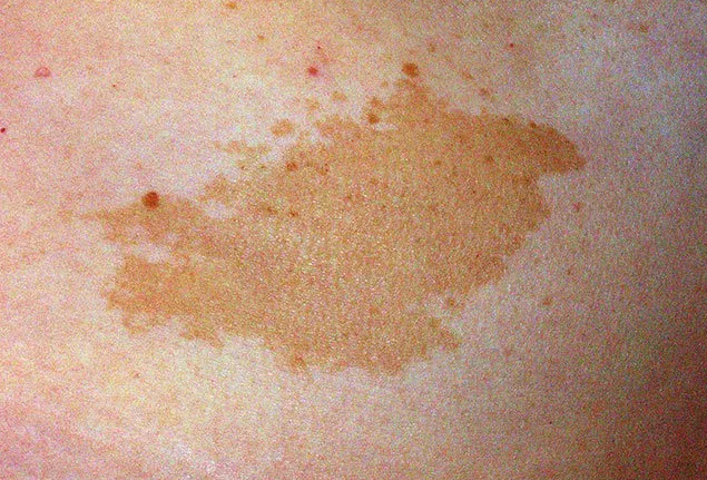 ماه گرفتگی پوستی؛ ردی که ژن‌ها بر تن می‌‌گذارند