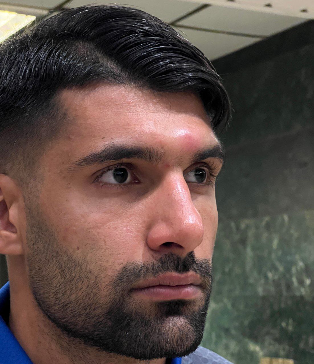 تورم پیشانی و بینی ابوالفضل سلیمانی بهعلت ضربه سر رامین رضاییان به او+تصاویر تورم پیشانی و بینی ابوالفضل سلیمانی بهعلت ضربه سر رامین رضاییان به او+تصاویر