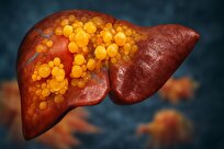 دارویی جدید برای درمان کبد چرب معرفی شد