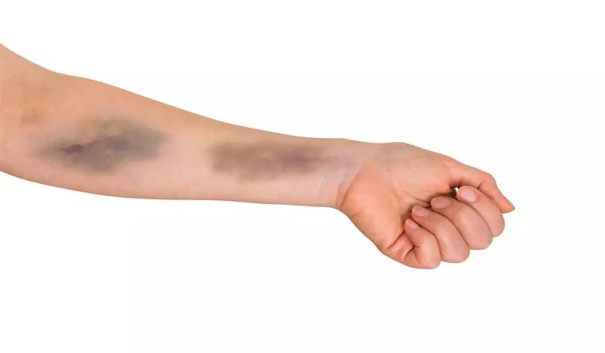 کبودیهای مرموز دست ترامپ و ملکه؛ علل پشت پرده این آسیبهای پوستی کبودیهای مرموز دست ترامپ و ملکه؛ علل پشت پرده این آسیبهای پوستی