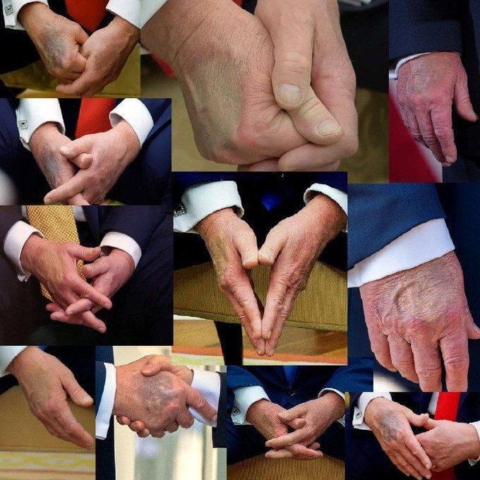 کبودیهای مرموز دست ترامپ؛ علل پشت پرده این آسیبهای پوستی چیست؟ کبودیهای مرموز دست ترامپ؛ علل پشت پرده این آسیبهای پوستی چیست؟