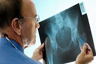 راهکاری نوین برای تشخیص و درمان آرتروز لگن در دانشکدگان فنی دانشگاه تهران