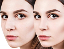 کاندید مناسب انجام عمل بینی چه کسانی هستند؟