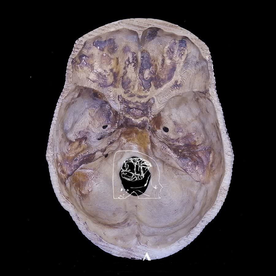 فناوری چاپ سه بعدی در پزشکی؛ از ارتز و پروتزهای سفارشی تا انواع مولاژها +فیلم و عکس