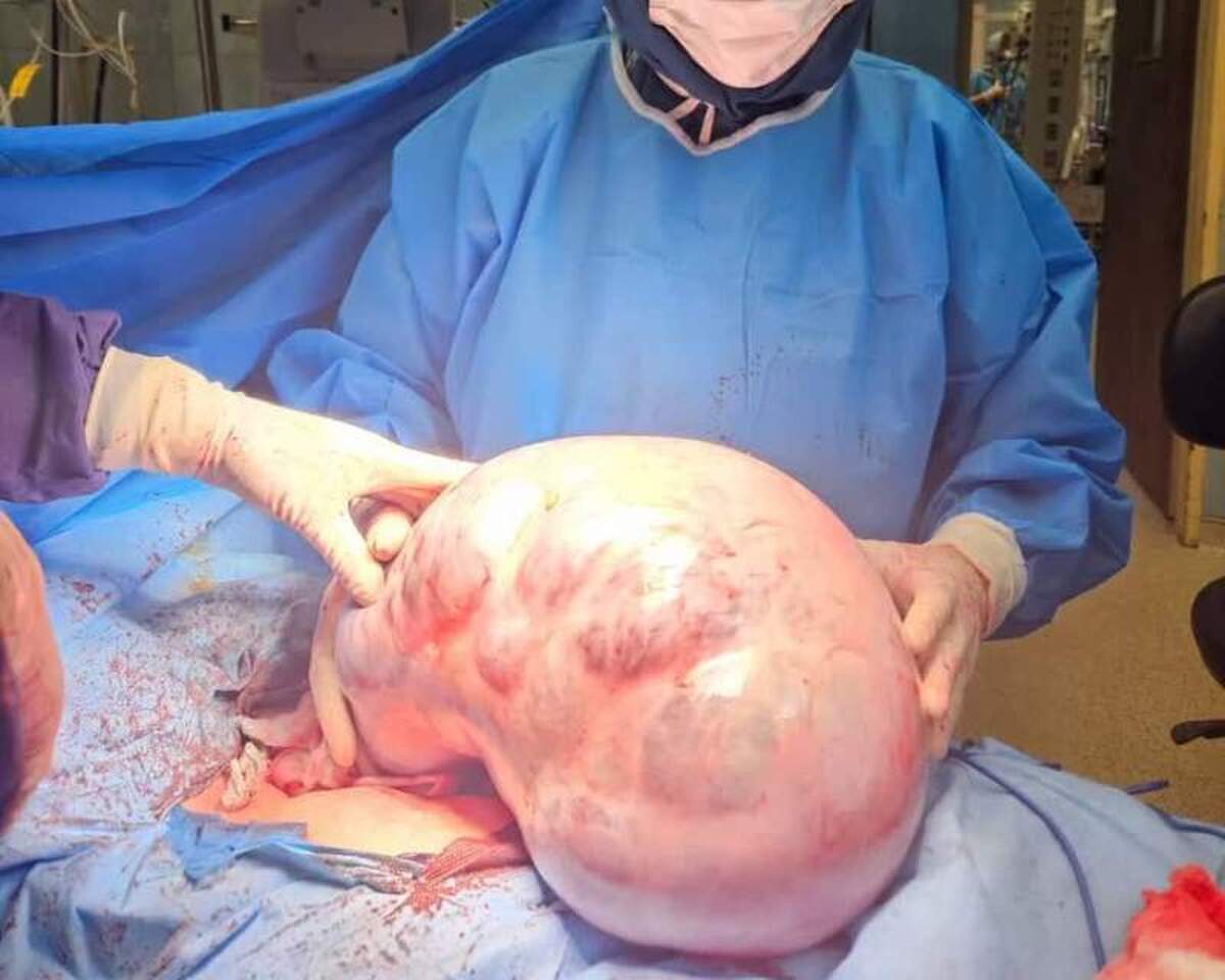 خارج‌ کردن توده ۱۰ کیلویی از شکم یک بیمار در کرج