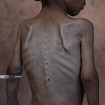 گرسنگی فاجعه بار در غزه