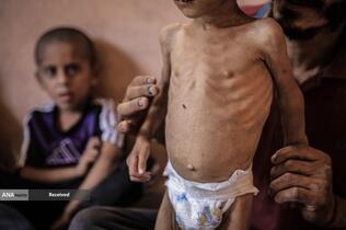 کودکانی که در غزه بر اثر گرسنگی تبدیل به اسکلت شده‌اند