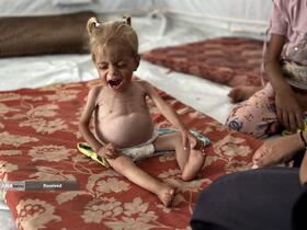 کودکانی که در غزه بر اثر گرسنگی تبدیل به اسکلت شده‌اند