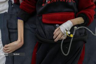 کودکانی که در غزه بر اثر گرسنگی تبدیل به اسکلت شده‌اند