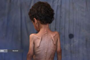 کودکانی که در غزه بر اثر گرسنگی تبدیل به اسکلت شده‌اند