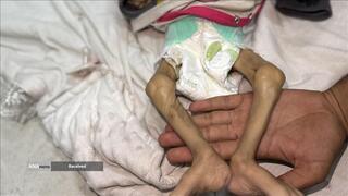 کودکانی که در غزه بر اثر گرسنگی تبدیل به اسکلت شده‌اند