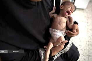 کودکان غزه در صف مرگ بدلیل سوء‌تغذیه، گرسنگی، و کمبود کمک‌ها و خدمات حیاتی