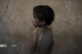 کودکان غزه در صف مرگ بدلیل سوء‌تغذیه، گرسنگی، و کمبود کمک‌ها و خدمات حیاتی