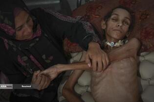 کودکان غزه در صف مرگ بدلیل سوء‌تغذیه، گرسنگی، و کمبود کمک‌ها و خدمات حیاتی