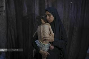 کودکان غزه در صف مرگ بدلیل سوء‌تغذیه، گرسنگی، و کمبود کمک‌ها و خدمات حیاتی
