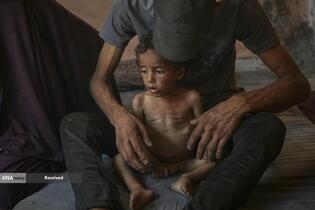 کودکان غزه در صف مرگ بدلیل سوء‌تغذیه، گرسنگی، و کمبود کمک‌ها و خدمات حیاتی