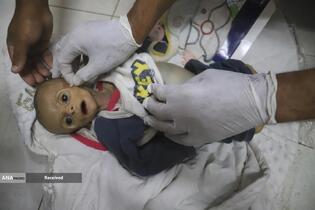 کودکان غزه در صف مرگ بدلیل سوء‌تغذیه، گرسنگی، و کمبود کمک‌ها و خدمات حیاتی