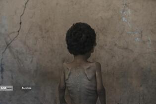 کودکان غزه در صف مرگ بدلیل سوء‌تغذیه، گرسنگی، و کمبود کمک‌ها و خدمات حیاتی