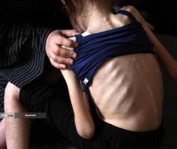 کودکان غزه در صف مرگ بدلیل سوء‌تغذیه، گرسنگی، و کمبود کمک‌ها و خدمات حیاتی