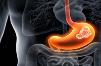 Diet rich in fruits and vegetables may lower stomach cancer risk, study finds