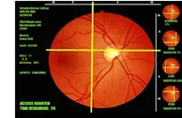 Innovative heat-based therapy could help prevent age-related vision loss