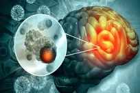 فقط ۲ درصد از تومورها در مغز و نخاع رخ می‌دهد؛ اما خطر بدخیمی بالاست